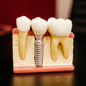 Benefits of Dental Implants: Improved Oral Health