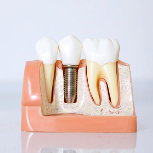 Can a Cosmetic Dentist Install Dental Implants? | Edison, NJ