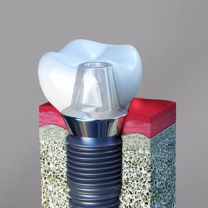 Dental Implants: Guide to Do's and Don'ts