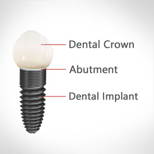 Dental Implants Surgery Edison