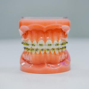 Can I Use Dental Braces if I Have a Dental Implant?