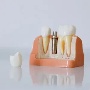 5 Key Reasons to Consider Dental Implants in Edison