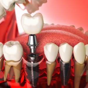 6 Common Myths and Facts About Dental Implants in Edison 6 Common Myths and Facts About Dental Implants in Edison