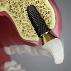 Can a Cosmetic Dentist Install Dental Implants?