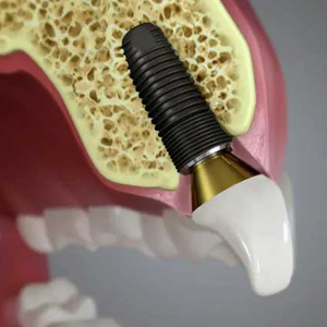 Can a Cosmetic Dentist Install Dental Implants? Can a Cosmetic Dentist Install Dental Implants?