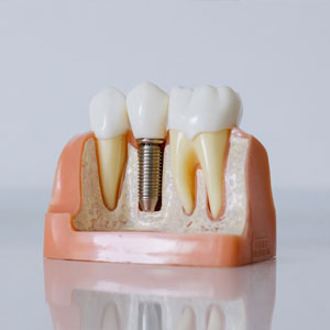 Dental Implants as Part of Cosmetic Dentistry | Edison Dental Implants as Part of Cosmetic Dentistry | Edison