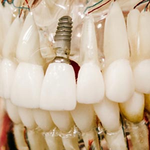 Dental Implants & Emergency Dentist | Kendall Park | Edison
