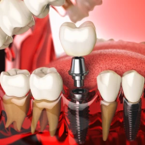 Illustration of dental implants in Edison showing single and multiple tooth replacement options