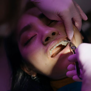 How Braces Move Teeth Every Day?