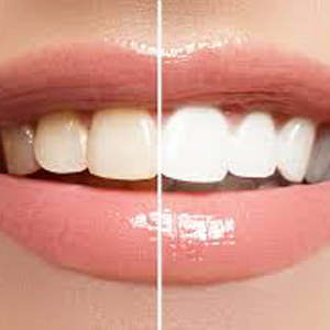 Importance of Teeth Whitening | Cosmetic Dentist Edison