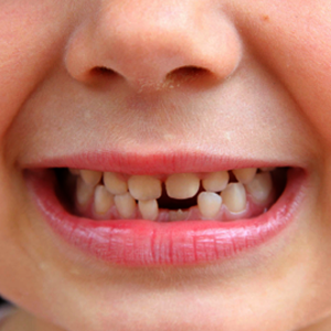 Restoration for tooth loss Restoration for tooth loss