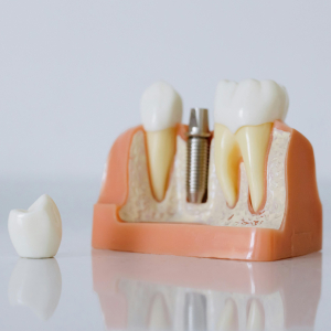 The Step-by-Step Guide to Getting Dental Implants in Edison The Step-by-Step Guide to Getting Dental Implants in Edison