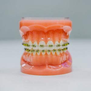Uses of Dental Braces and Implant | Edison | Kendall Park Uses of Dental Braces and Implant | Edison | Kendall Park