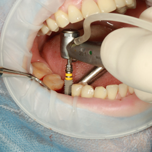 Why Would I Need Emergency Dental Implants? | Edison, NJ
