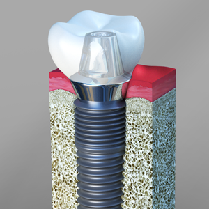 Dental Implants dentistry Edison NJ