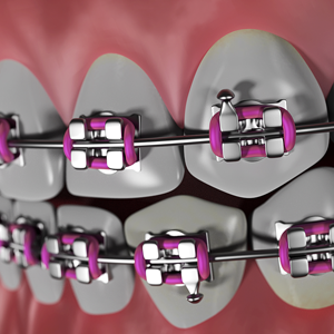 Dental Braces Dentist Edison NJ